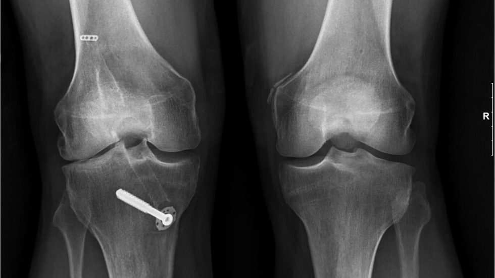 Stem Cell Therapy For Knees NeoGenix Stem Cells