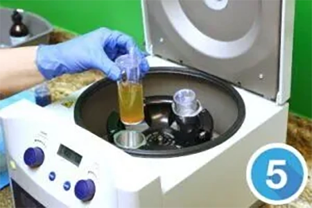 Step 5: Platelet Rich Plasma (PRP) Treatment
